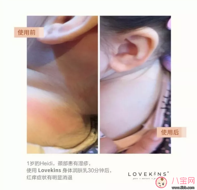 LOVEKINS面霜怎么样对湿疹有效果吗 LOVEKINS面霜成分好不好 LOVEKINS面霜怎么样对湿疹有效果吗 LOVEKINS面霜成分好不好