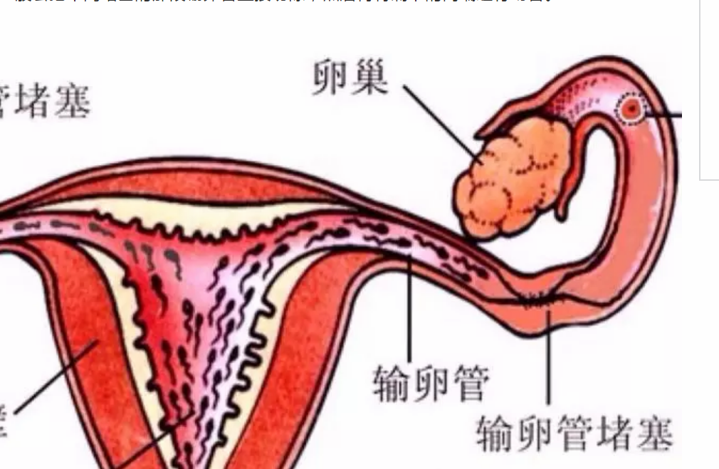 跳绳能疏通输卵管吗 输卵管堵塞能疏通吗