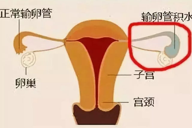 输卵管积水能做试管婴儿吗 输卵管积水怎么预防2018