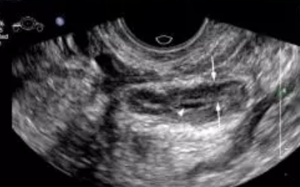 输卵管结核可以做试管婴儿吗 输卵管结核停药多久可以做试管婴儿