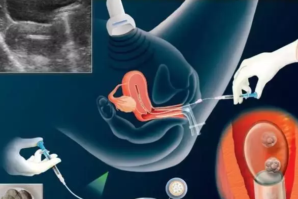 胚胎成功移植一定能怀孕吗 试管婴儿成功移植胚胎不怀孕怎么办