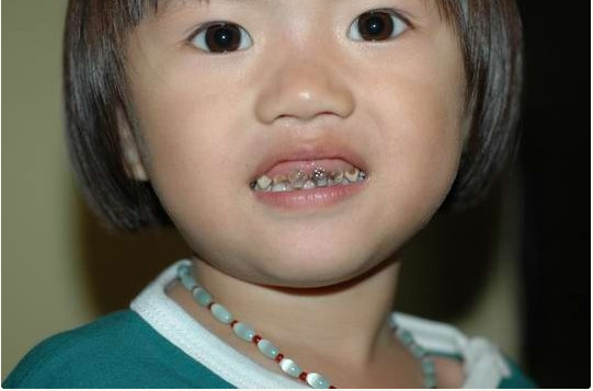 婴儿期如何预防蛀牙 蛀牙是怎么来的