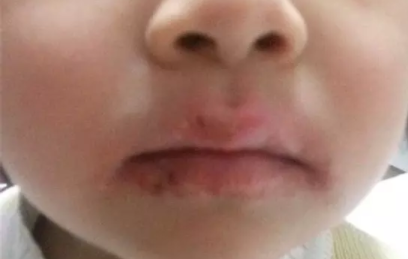 宝宝嘴唇干裂什么原因  引起嘴唇干裂的四大原因