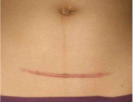 剖腹产疤痕增生怎么回事 疤痕增生用什么药好