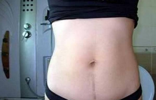 剖腹产疤痕增生怎么回事 疤痕增生用什么药好