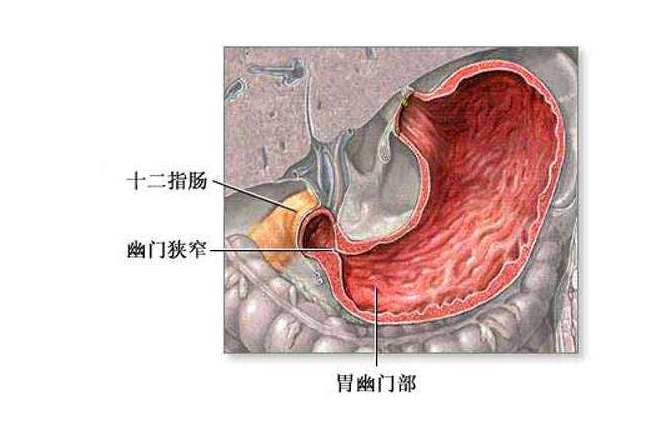 新生儿幽门狭窄严重吗 新生儿幽门狭窄如何治疗