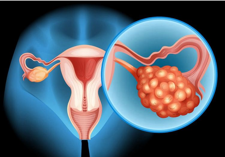 怀孕后得了卵巢癌怎么办  哪些人容易得卵巢癌