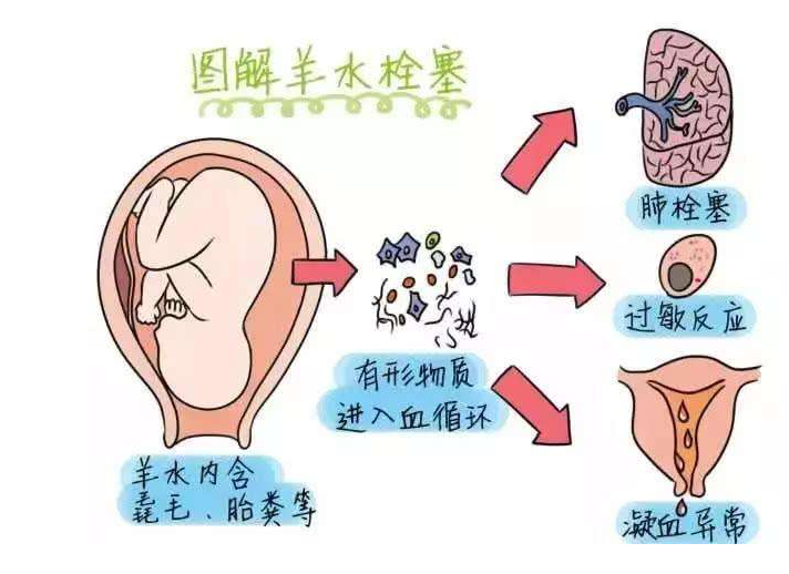  产妇咳嗽是羊水栓塞吗 羊水栓塞为什么咳嗽