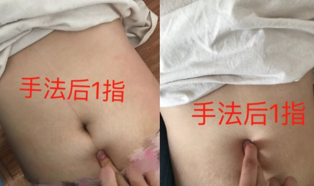 产后腹直肌分离自测图解 腹直肌分离自测方法