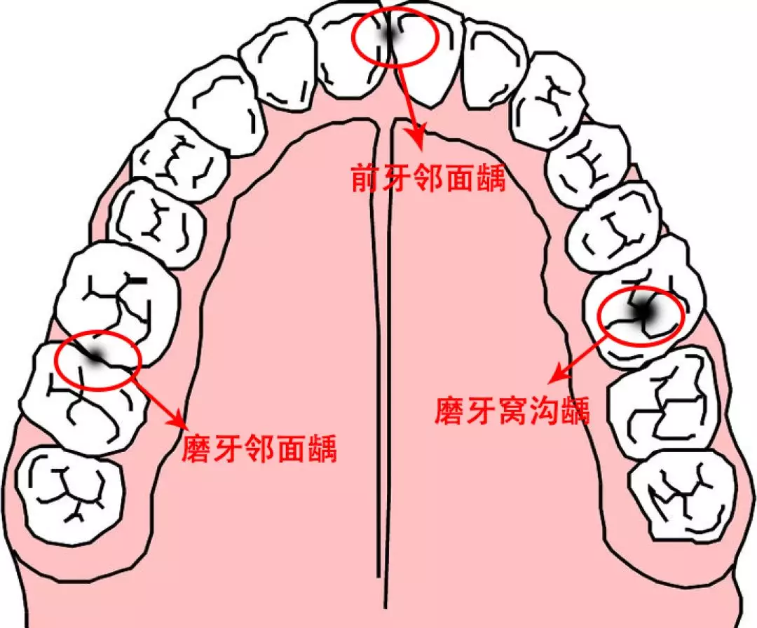 孩子有龋齿是什么原因导致的 孩子发龋病的主要原因是什么