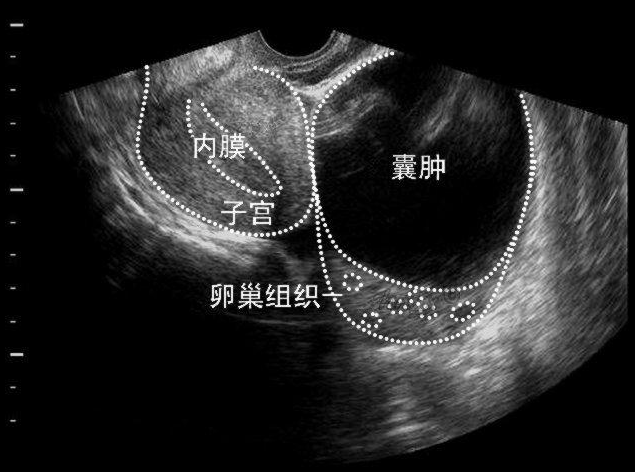 卵巢囊肿会自己消失吗 卵巢囊肿不及时治疗有什么后果