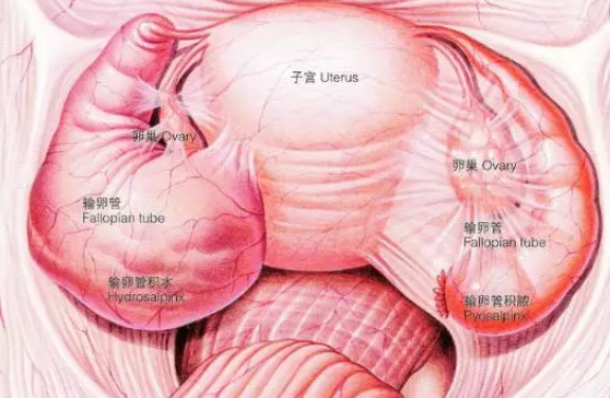 输卵管积液是什么意思 输卵管积水的检查方法