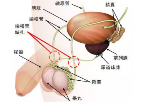 男性结扎有后遗症吗 男性结扎的并发症