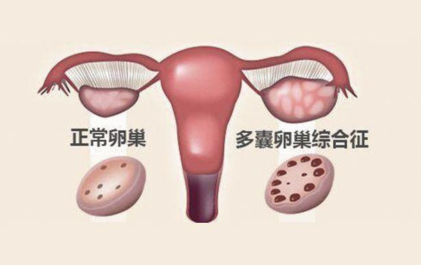 多囊卵巢综合征怀孕初期要注意什么 多囊卵巢综合征怀孕注意事项