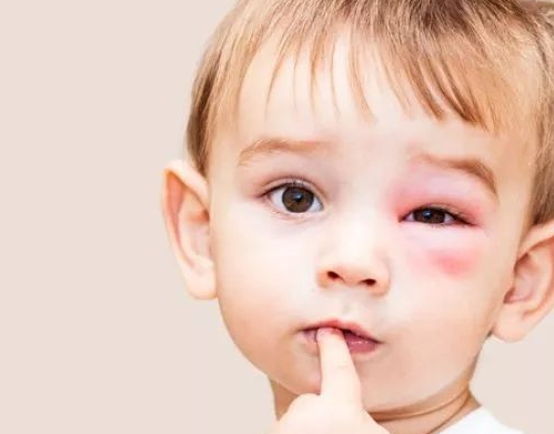 新生儿如何预防宝宝被蚊虫叮咬 孩子被蚊子咬了怎么办