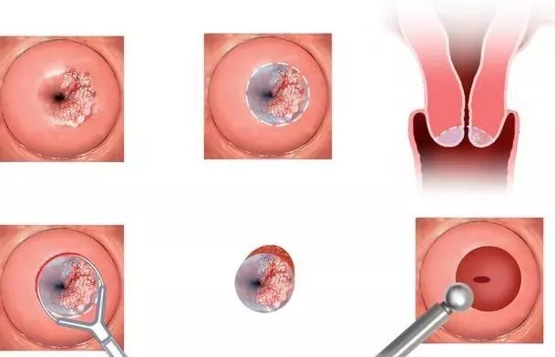 宫颈糜烂术后会影响生育吗 宫颈糜烂怎么治疗