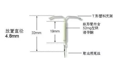 曼月乐环要多少钱 上曼月乐环多少钱一个