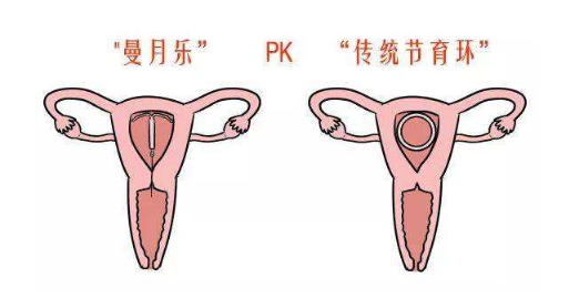 曼月乐环适用哪种人 带曼月乐环都有哪些效果