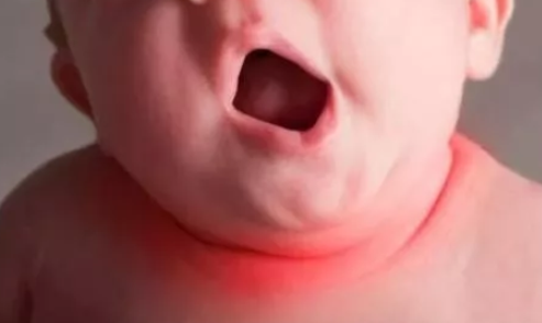 ​宝宝淹脖子破皮怎么办 宝宝淹脖子症状有哪些