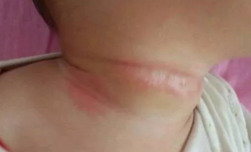 宝宝淹脖子可以用爽身粉吗 宝宝淹脖子用爽身粉护理好不好 宝宝淹脖子可以用爽身粉吗 宝宝淹脖子用爽身粉护理好不好