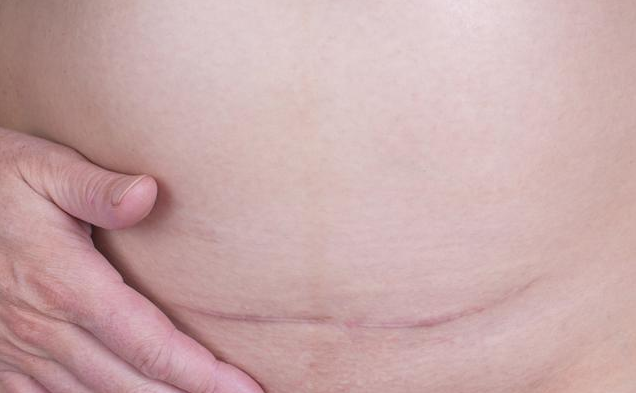 剖腹产疤痕又痒又疼是怎么回事 产后伤口发痒应对方法