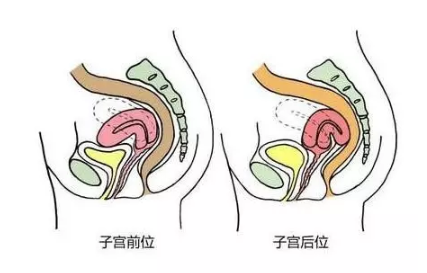 子宫后位应该怎么备孕 手术能纠正子宫后位吗