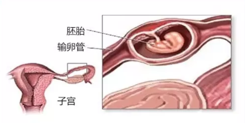 输卵管通而不畅可以喝中药吗 卵管通而不畅喝中药效果好吗