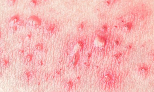 生殖器上长水泡是生殖器疱疹吗 有生殖器疱疹可以过性生活吗