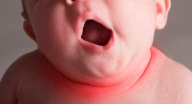 宝淹脖子发红怎么护理 如何避免淹脖子复发 宝淹脖子发红怎么护理 如何避免淹脖子复发