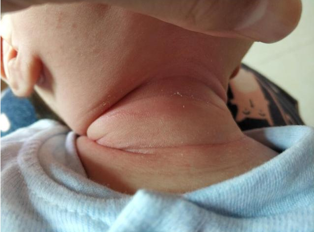 宝淹脖子发红怎么护理 如何避免淹脖子复发 宝淹脖子发红怎么护理 如何避免淹脖子复发