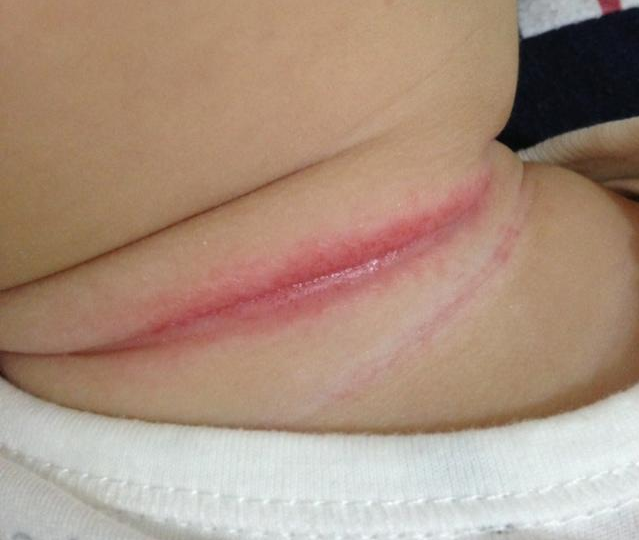 宝淹脖子发红怎么护理 如何避免淹脖子复发 宝淹脖子发红怎么护理 如何避免淹脖子复发