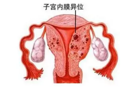 治疗子宫内膜异位症要吃避孕药吗 治疗子宫内膜异位症的方法