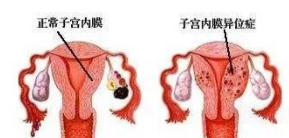 子宫内膜异位症手术后能怀孕吗 子宫内膜异位症会痛经吗