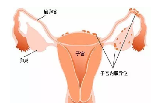 子宫内膜异位症手术后能怀孕吗 子宫内膜异位症会痛经吗