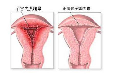 子宫内膜太薄不来月经怎么办 子宫内膜太薄和不来月经有关吗