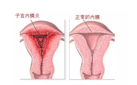 子宫内膜炎怎么检查出来 慢性子宫内膜炎要做哪些检查