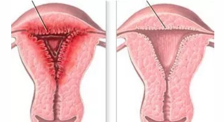 急性子宫内膜炎的发病原因 急性子宫内膜炎严重吗