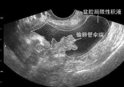 盆腔积液治疗效果不明显原因 B超检查有少量盆腔积液严重吗