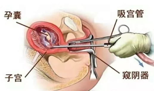 宫腔粘连是怎么回事 宫腔粘连要做什么检查判断