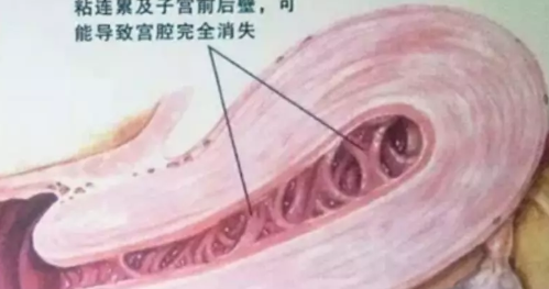 宫腔粘连是怎么回事 宫腔粘连要做什么检查判断