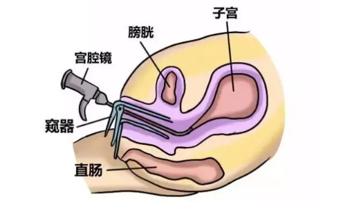 宫腔异常出血是怎么回事 宫腔异常出血怎么检查治疗