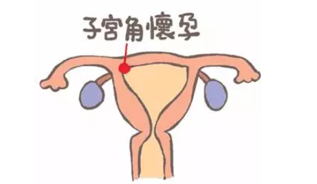 宫角妊娠回正位的办法 宫角妊娠能成功生育吗