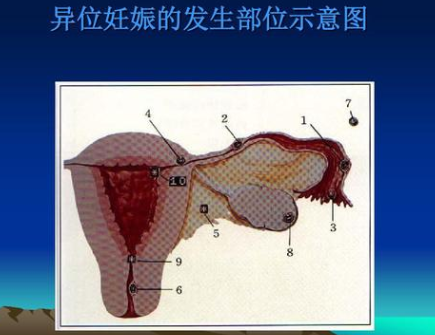 宫角妊娠最佳治疗方法 宫角妊娠的治疗方法有哪些