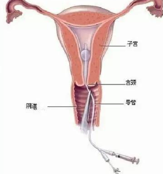 宫腔镜检查疼不疼 宫腔镜检查能检查哪些疾病