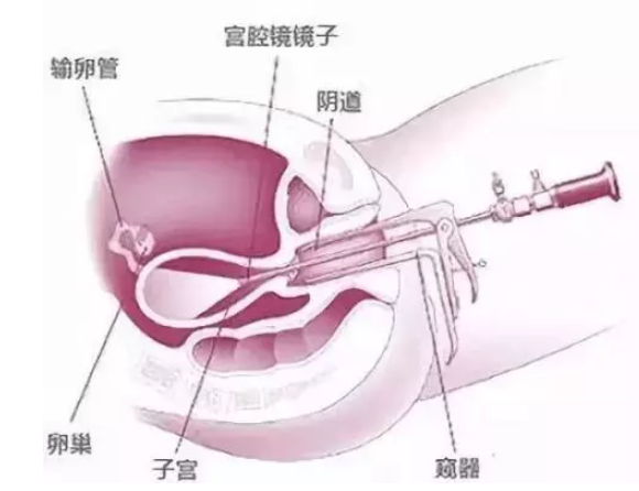 宫腔镜检查疼不疼 宫腔镜检查能检查哪些疾病