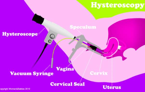 宫腔镜检查需要麻醉吗 宫腔镜检查详细流程