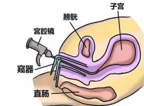 宫腔镜检查后多久可以同房 宫腔镜检查后多久可以有性生活