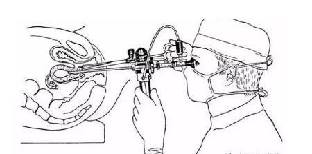 宫腔镜检查要住院吗 宫腔镜能检查哪些疾病