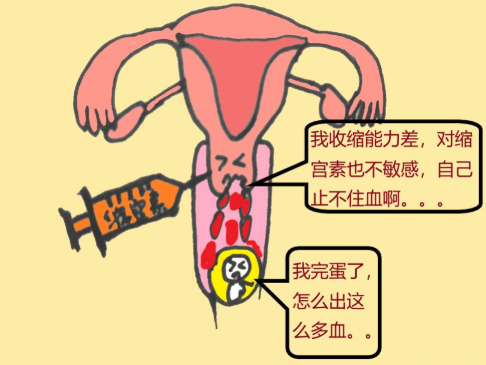 宫颈妊娠要做清宫手术吗 宫颈妊娠要做什么治疗最好