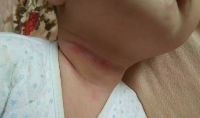 孩子有淹脖子可以用痱子粉吗 孩子淹脖子了怎么治疗 孩子有淹脖子可以用痱子粉吗 孩子淹脖子了怎么治疗